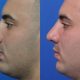 Male nose surgery