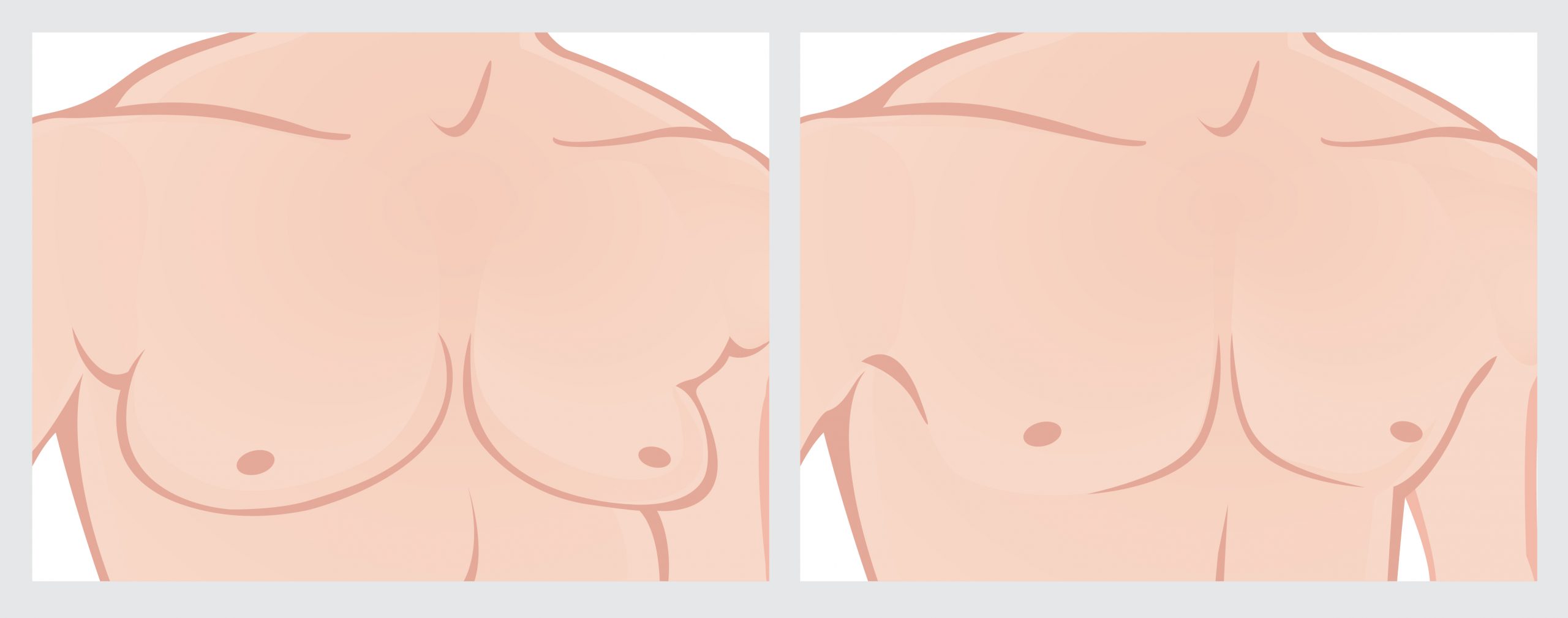 breast reduction surgery