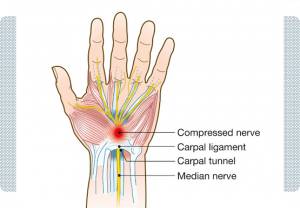 Best Hand nerve damage repair surgery in Lahore, Pakistan