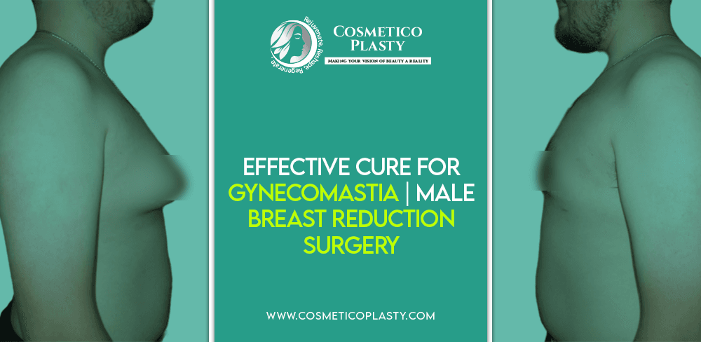 Effective Cure for Gynecomastia