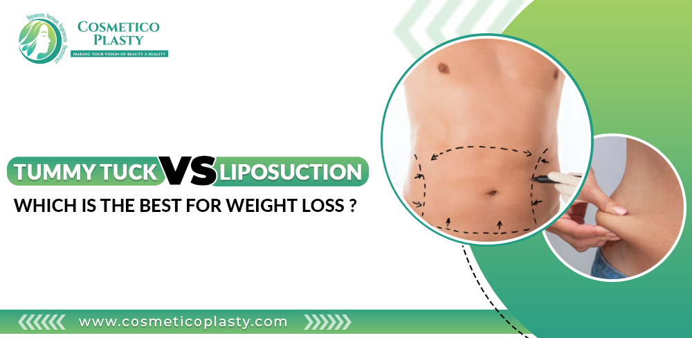 Tummy tuck vs Liposuction