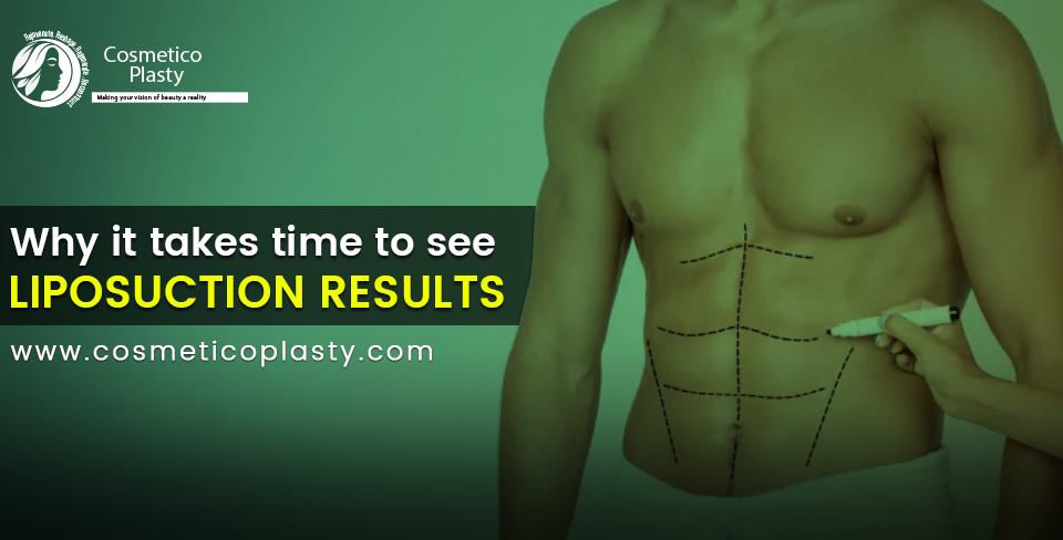 see liposuction results