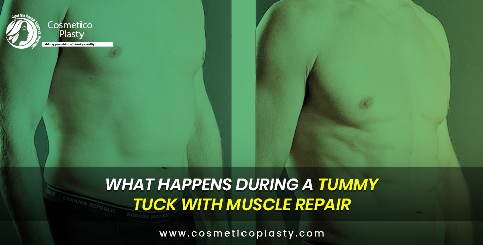 tummy tuck with muscle repair