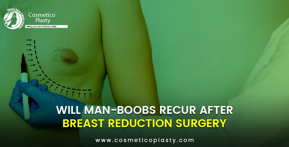 man-boobs recur after gynecomastia surgery