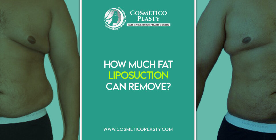 fat liposuction can remove