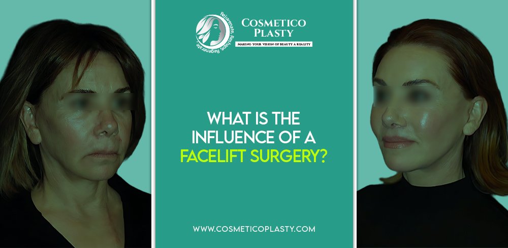 Facelift Surgery