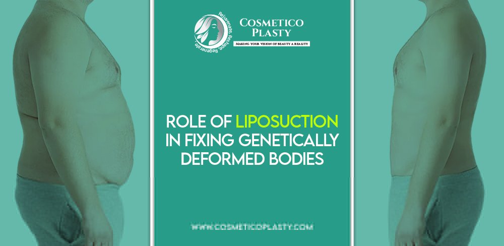 Role of Liposuction