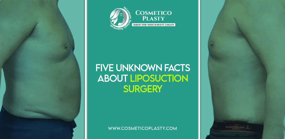 Facts About Liposuction Surgery