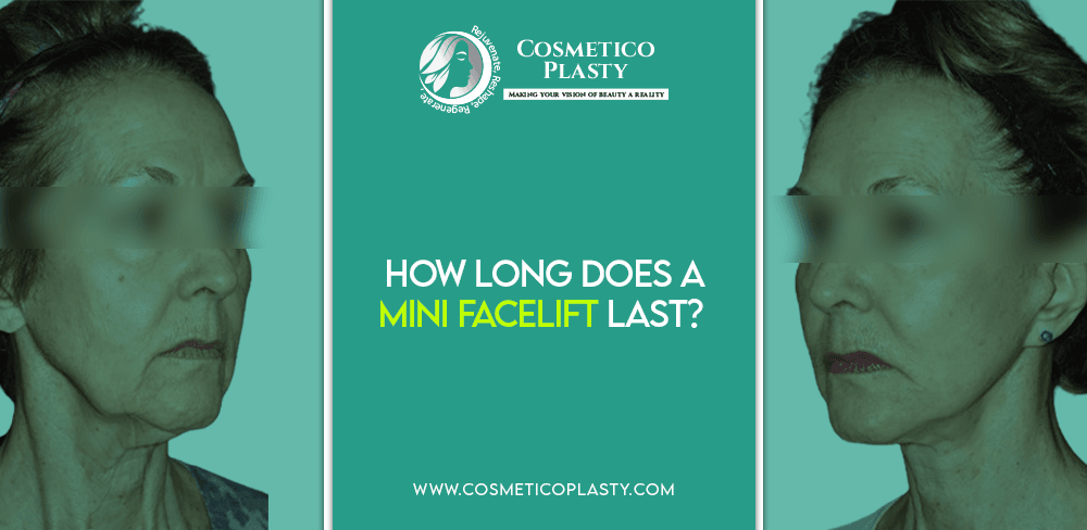 How Long Does a Mini Facelift Last