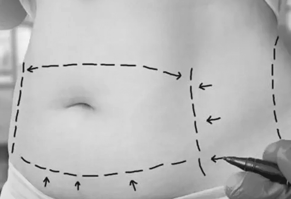 Tummy Tuck Surgery