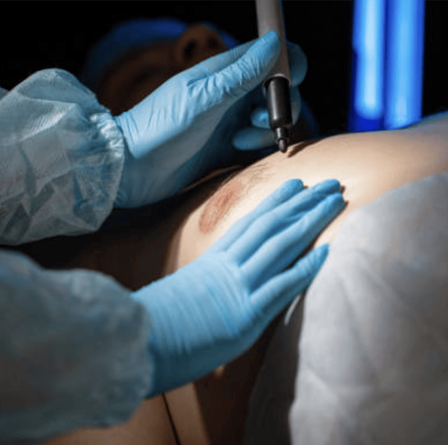 side effects of gynecomastia surgery