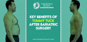 Tummy Tuck After Bariatric Surgery