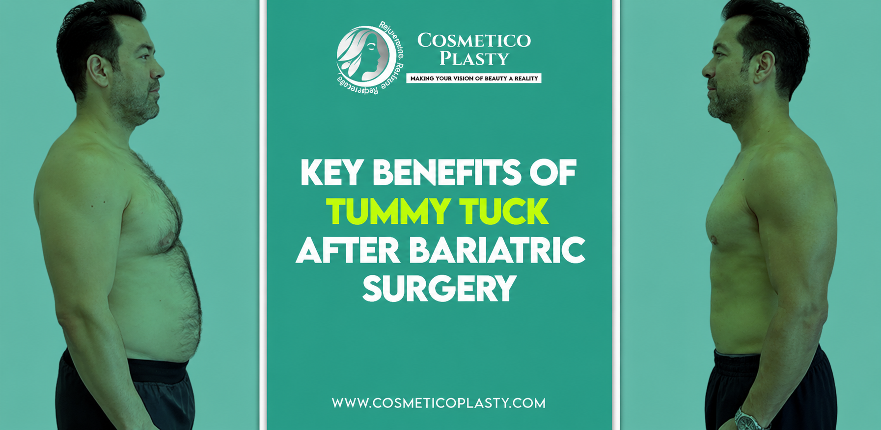 Tummy Tuck After Bariatric Surgery