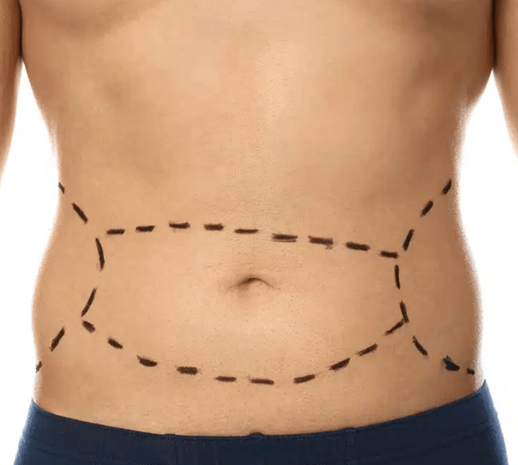 Tummy Tuck After Bariatric Surgery