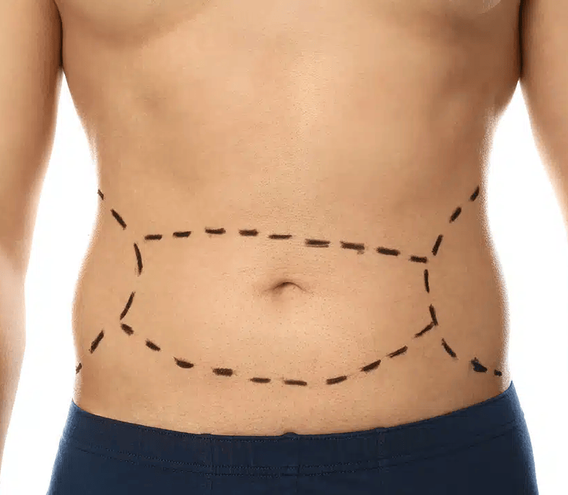 Tummy Tuck After Bariatric Surgery
