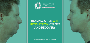 bruising after chin liposuction